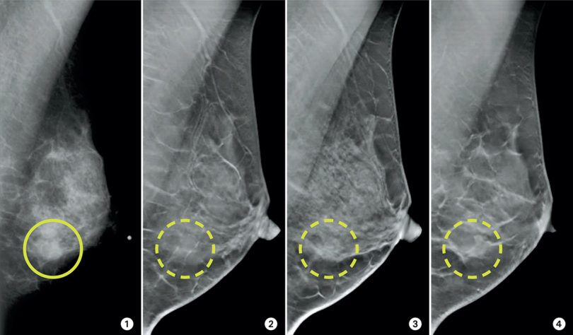 Screening Mammogram Thelys